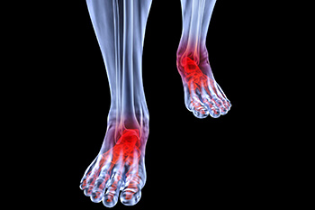 arthritic foot and ankle care treatment in the Fair Lawn, NJ 07470, Montclair, NJ 07042 and Randolph, NJ 07869 area