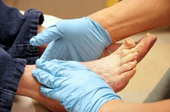 Diabetic foot treatment in the Fair Lawn, NJ 07470, Montclair, NJ 07042 and Randolph, NJ 07869 area