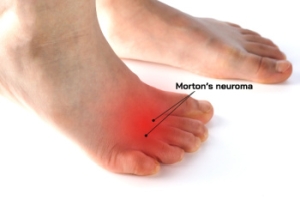 When Nerve Pain Stops You Mid-Step