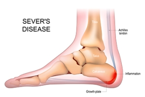 Understanding Sever&rsquo;s Disease in Growing Children