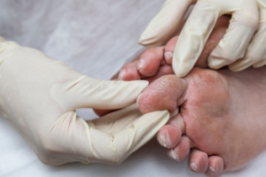 Diabetes and Foot Health
