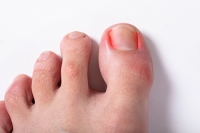 What Can I Do About Ingrown Toenails?