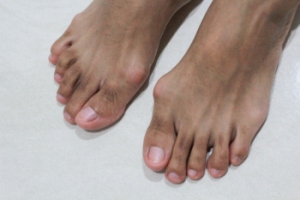When Bunions Become More Than a Bump