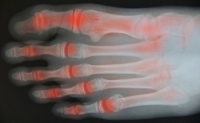 Psoriatic Arthritis and Foot Care