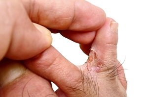 Understanding Athlete&rsquo;s Foot and How to Treat It