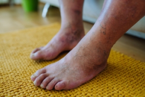 Protecting Your Diabetic Feet
