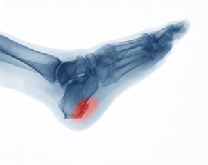 Stretching the Feet May Help Heel Spurs