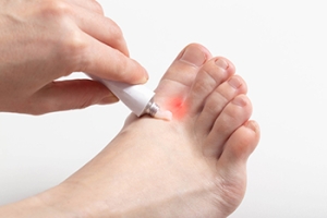 What Are the Symptoms of Athlete&rsquo;s Foot?